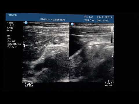 Subhepatic Appendix US short clip