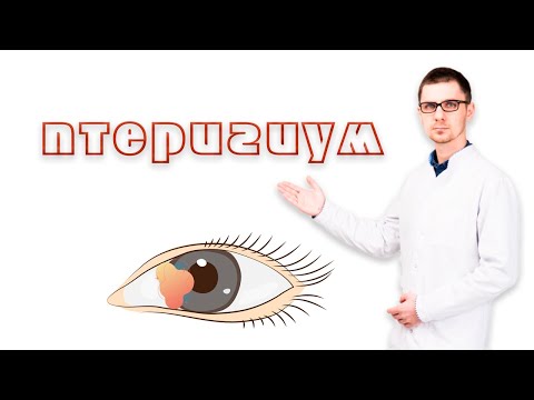 Птеригиум или пленка на глазу