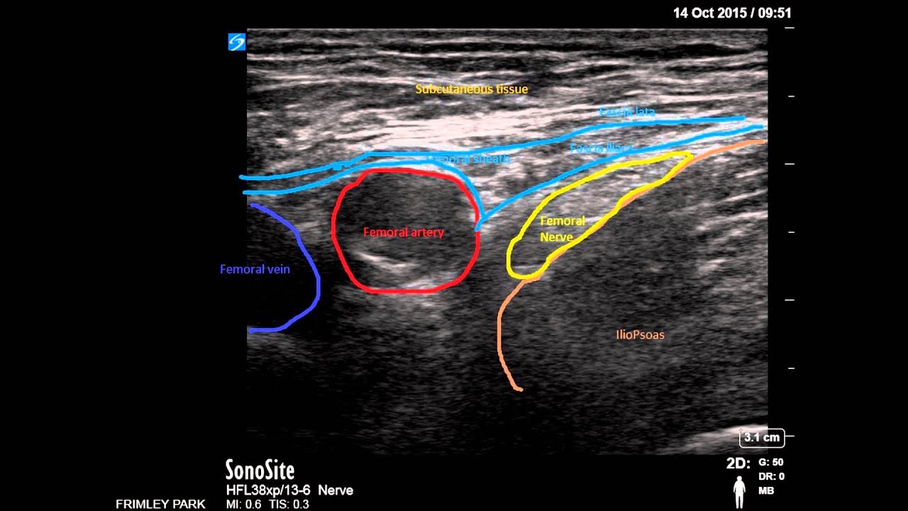 Ultrasound guided Femoral nerve block - YouTube