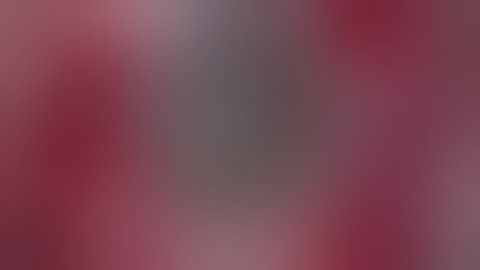 Repositioning of A Pseudoexfoliative Dislocated IOL-Capsular Complex 10 Years After Cataract Surgery