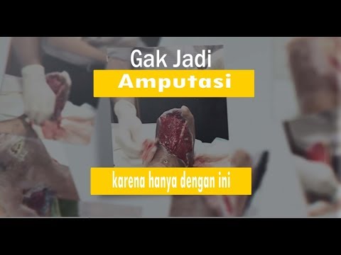 Dulu Mau Diamputasi Sebab Diabet Sekarang Sudah Bebas Makan Apa Saja Alga Gold Cereal Alga Tea Dulu Mau Diamputasi Sebab Diabet Sekarang Sudah Bebas Makan Apa Saja Alga Gold Cereal Alga Tea