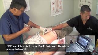 Ultrasound Guided Stem Cell Injections For Chronic Lower Back Pain.