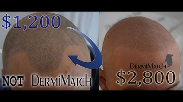 Scalp Micropigmentation in Phoenix, Arizona