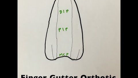 Finger gutter orthotic/splint in hand therapy setting
