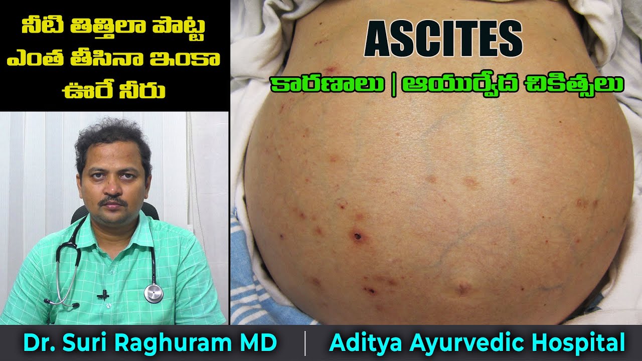 పొట్టలో నీరు ఎందుకు నిలిచిపోతుంది?  | Ascites Ayurvedic Treatment