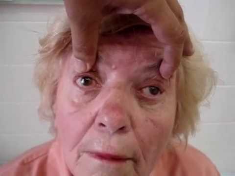 Video myasthenia gravis, ocular, clinical tests - youtube