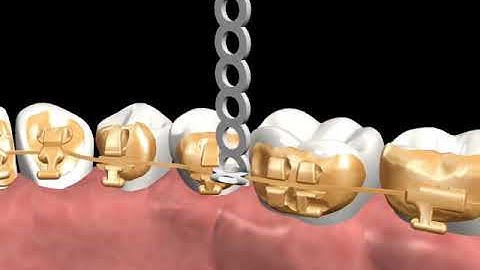 Incognito™ Appliance System Clinical Guide 06: Lasso Elastic (Conventional Lasso)