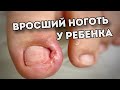 Вросший ноготь / Лечение / Скобы для ногтей