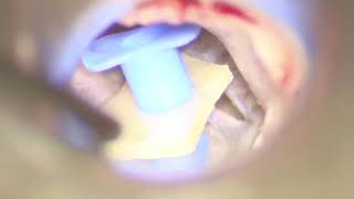 Placement of a Cartilage Anchored Tympanostomy Tube by Michael Teixido MD 1,347 views 3 years ago 1 minute, 56 seconds
