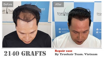 Sửa tóc cấy hỏng| Failed Hair Transplant Repair| By Truehair team Hanoi Vietnam