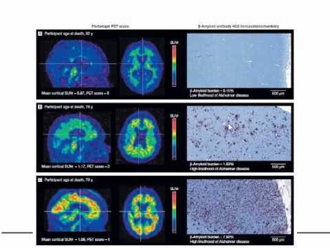 Vidéo: Imagerie TEP De MGluR5 Dans La Maladie D'Alzheimer