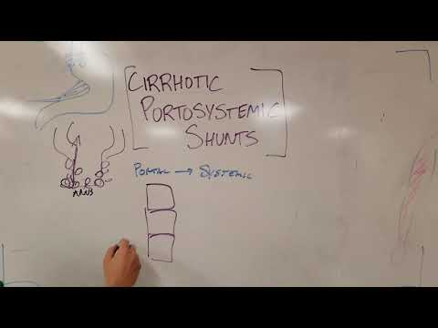 Portal Hypertension and Cirrhosis: Varices, Hemorrhoids, and Other Portosystemic Shunts