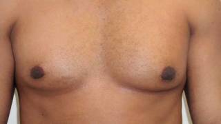 Gynecomastia - Plastic Surgeon specializes in helping men with enlarged breasts