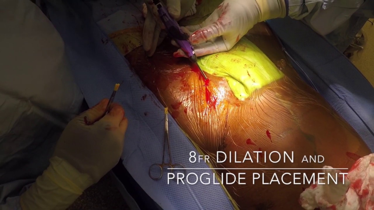 cardiopulmonary bypass cannulation