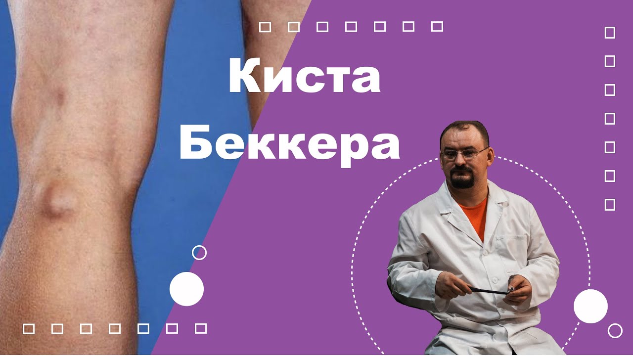 Киста Беккера в коленном суставе - YouTube
