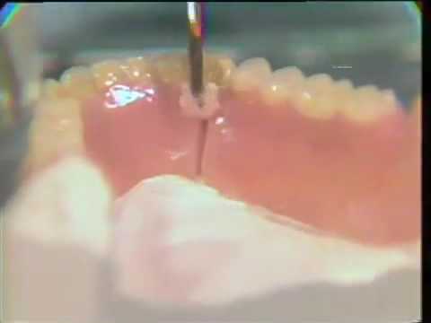 Repairing a Broken Denture - YouTube