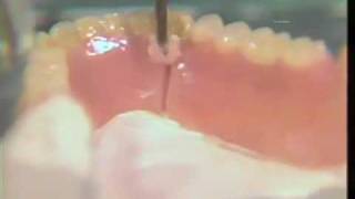 Repairing a Broken Denture