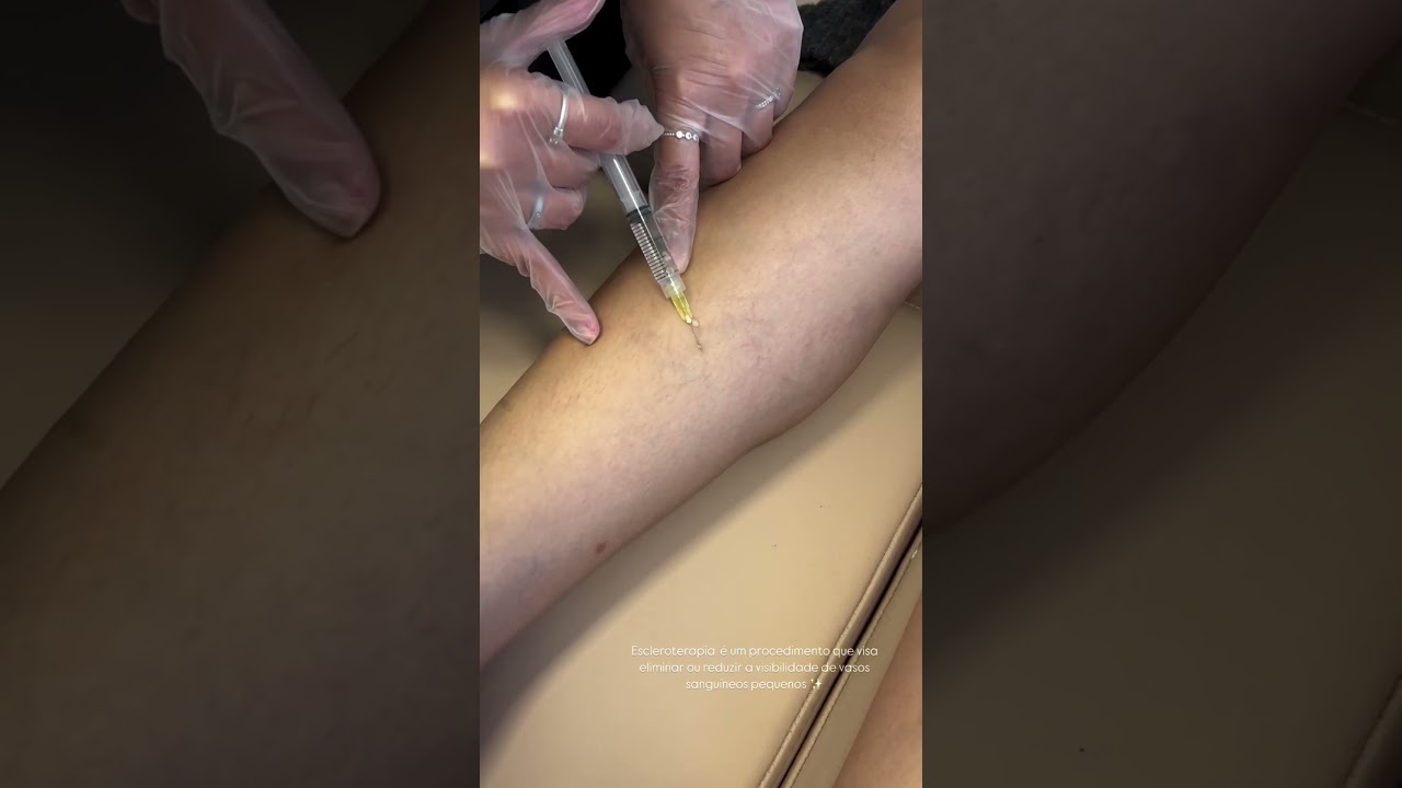 Secagem de Vasinhos (PEIM) em Campo Limpo | Beauty Clinic
