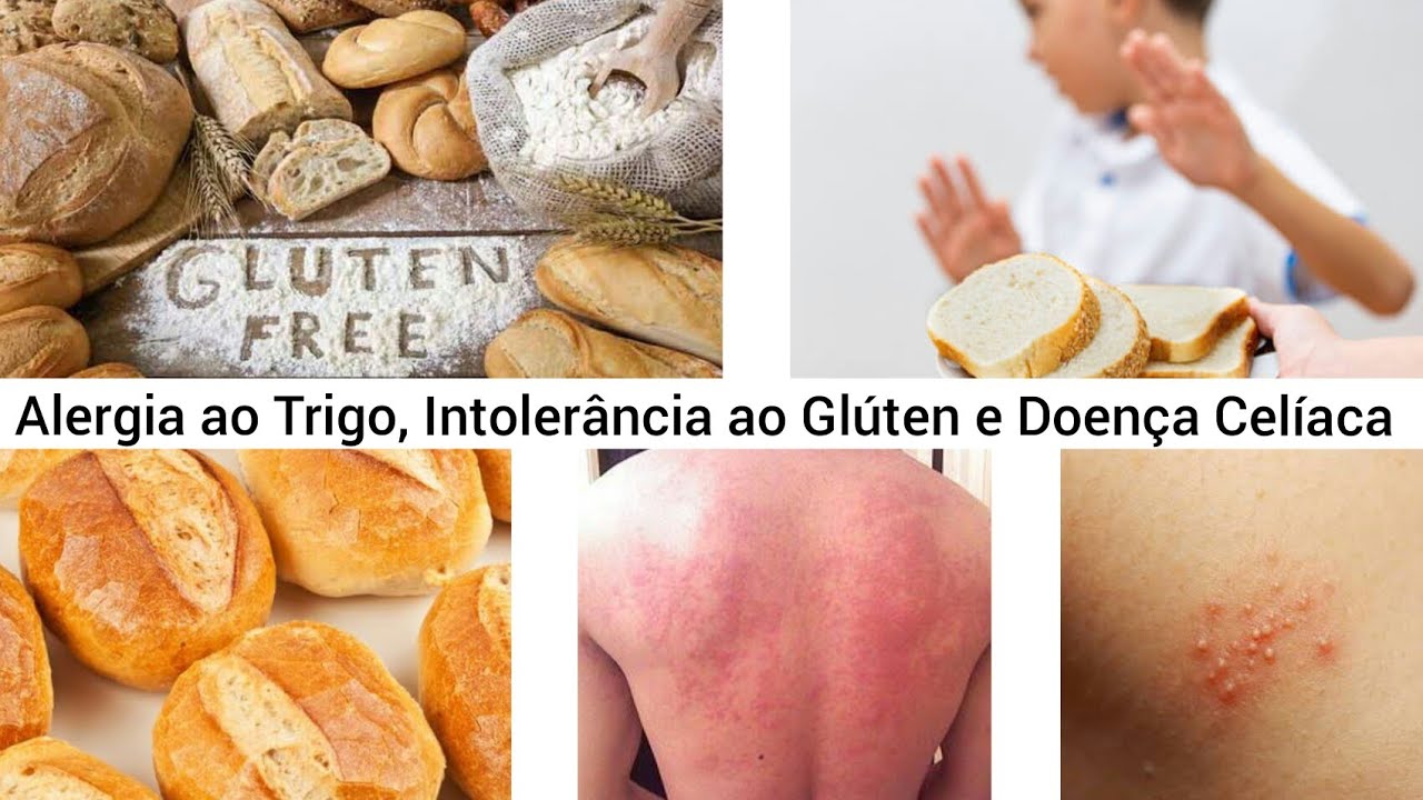 Síntomas de alergia al gluten