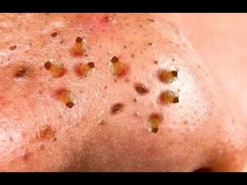 how-to-removal-blackhead-and-how-to-get-rid-of-blackhead-blackhead-on-face-#1