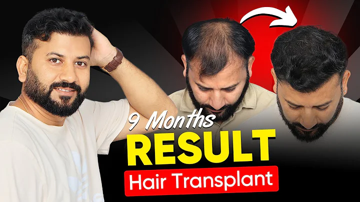 Unbelievable 9-Month Hair Transplant Result (HXQSDN) – Before & After