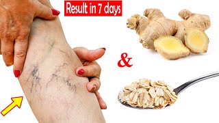 Best natural treatment for Spider veins (venous insufficiency) result in 7 days