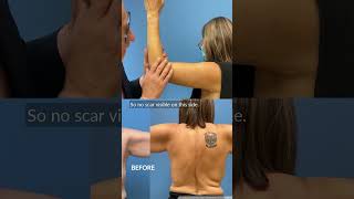 How to place an arm lift scar #shorts #brachioplasty #scarreveal