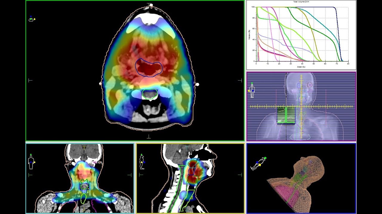 Лечение опухолей горла и голосовых связок в Израиле