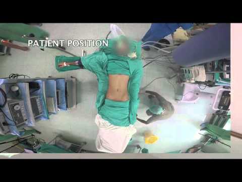 Laparoscopic Appendectomy Procedure