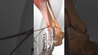 Ruptured ACHILLES TENDON! 😳 #shortsexcellence