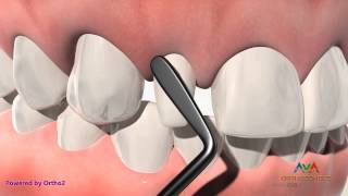 Orthodontic & Restorative Treatment for Small or Peg Lateral Incisor - Composite Build Up