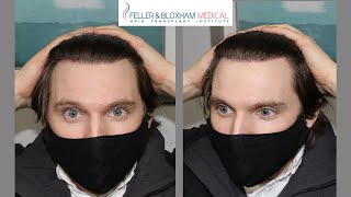 The "Hollywood Hairline" and Temple Work | Hair Transplant Results | Feller & Bloxham, NY, NYC, LI