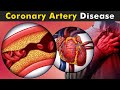 How Coronary Artery Disease Work? | Symptoms, Causes And Treatment (Urdu/Hindi)