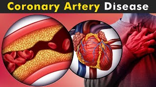 How Coronary Artery Disease Work? | Symptoms, Causes And Treatment (Urdu/Hindi) screenshot 5