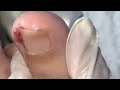 Ep_6562 Ingrown toenail removal 👣 เล็บไม่ค่อยน่าห่วง แต่เนื้อปูดแดงต้องดูแล 😄 (clip from Thailand)