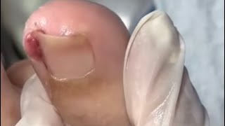 Ep_6562 Ingrown toenail removal 👣 เล็บไม่ค่อยน่าห่วง แต่เนื้อปูดแดงต้องดูแล 😄 (clip from Thailand)