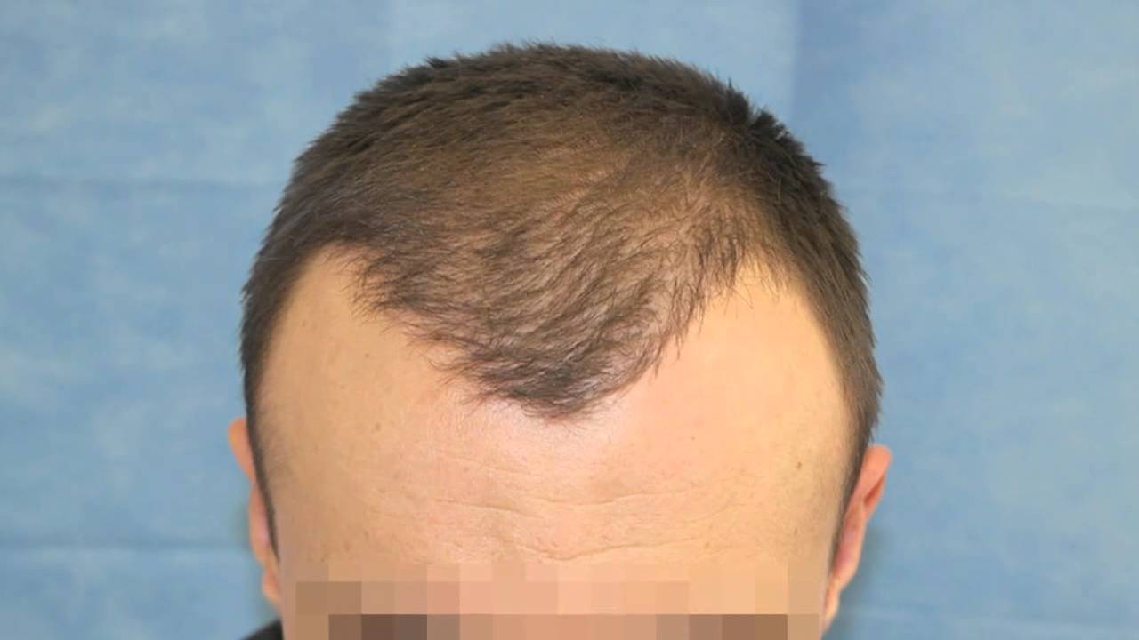FUE by Dr Reddy 36 year old gentleman with Norwood 4, 1374 grafts