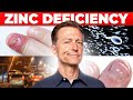 Zinc deficiency the 7 symptoms youve never heard about