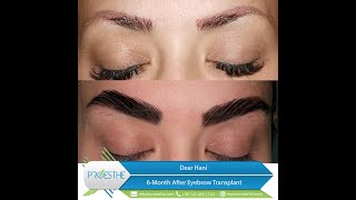 Eyebrow Transplant Istanbul/ Turkey, Patient's satisfaction. Before and after Eyebrow transplant.