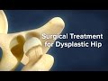 Surgical Treatment for Dysplastic Hip | Cincinnati Children