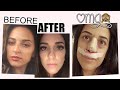 MY NOSE JOB (REVISION RHINOPLASTY) EXPERIENCE IN TURKEY | my botched nose & travelling alone |PART 1