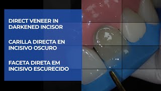 Direct veneer in darkened incisor/ Carilla directa en incisivo oscuro/ Faceta direta em dente escuro