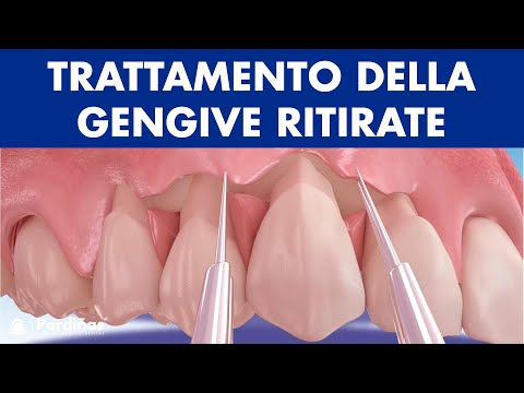 Video: Cos'è il lembo avanzato coronalmente?