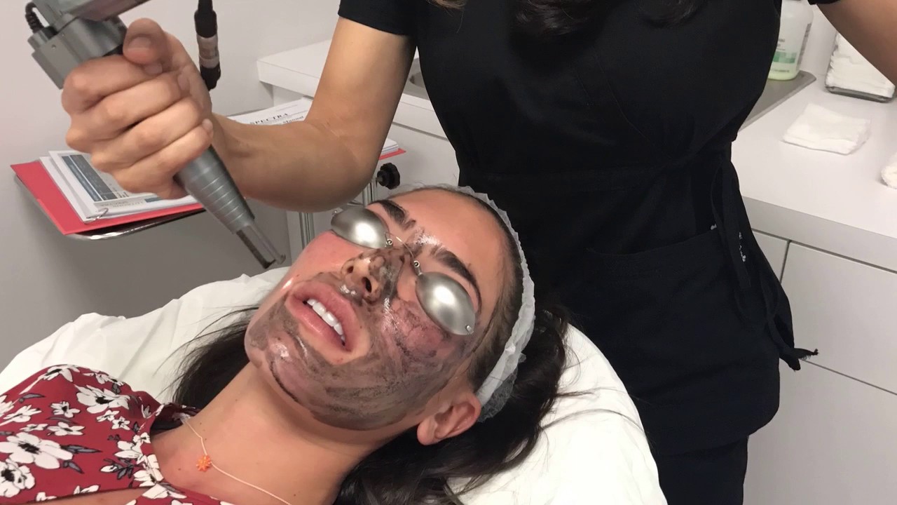 MetroMD Carbon X Peel for Skin Restoration,  Acne Treatment, Wrinkles, Hyper Pigmentatiion, etc