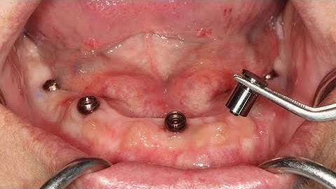 Final Impressions for the LOCATOR F-Tx Prostheses - Impression Coping Technique