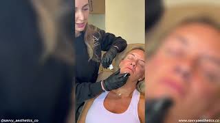 Radiesse, Dermal Filler & Tox: Full Treatment Walkthrough