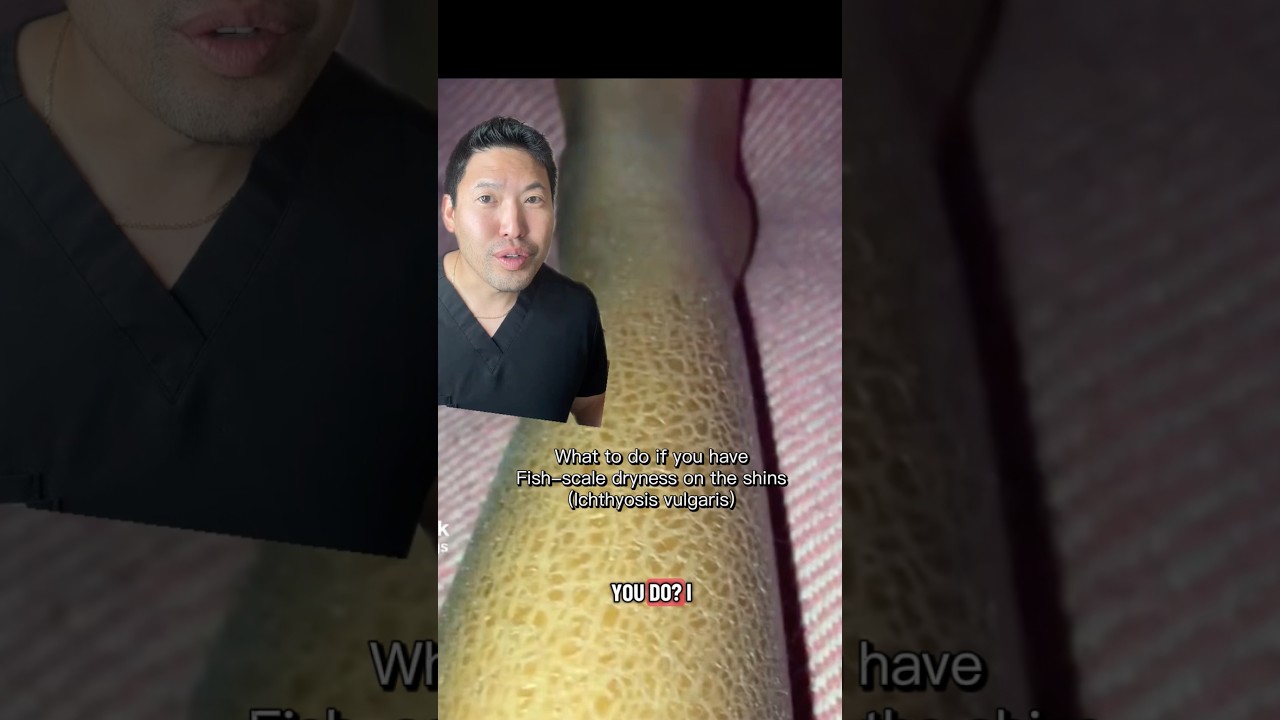 Dermatologist Explains Ichthyosis Vulgaris