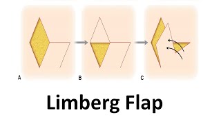 Rhomboid Eksizyon ve Limberg Flep