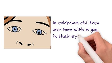 Microphthalmia, Anophthalmia and Coloboma