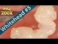 #5 Squeezing Whiteheads Close up 200X